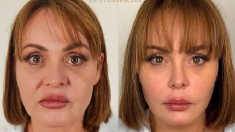Gabriela Spanic surpreende ao mostrar antes e depois de harmonização facial