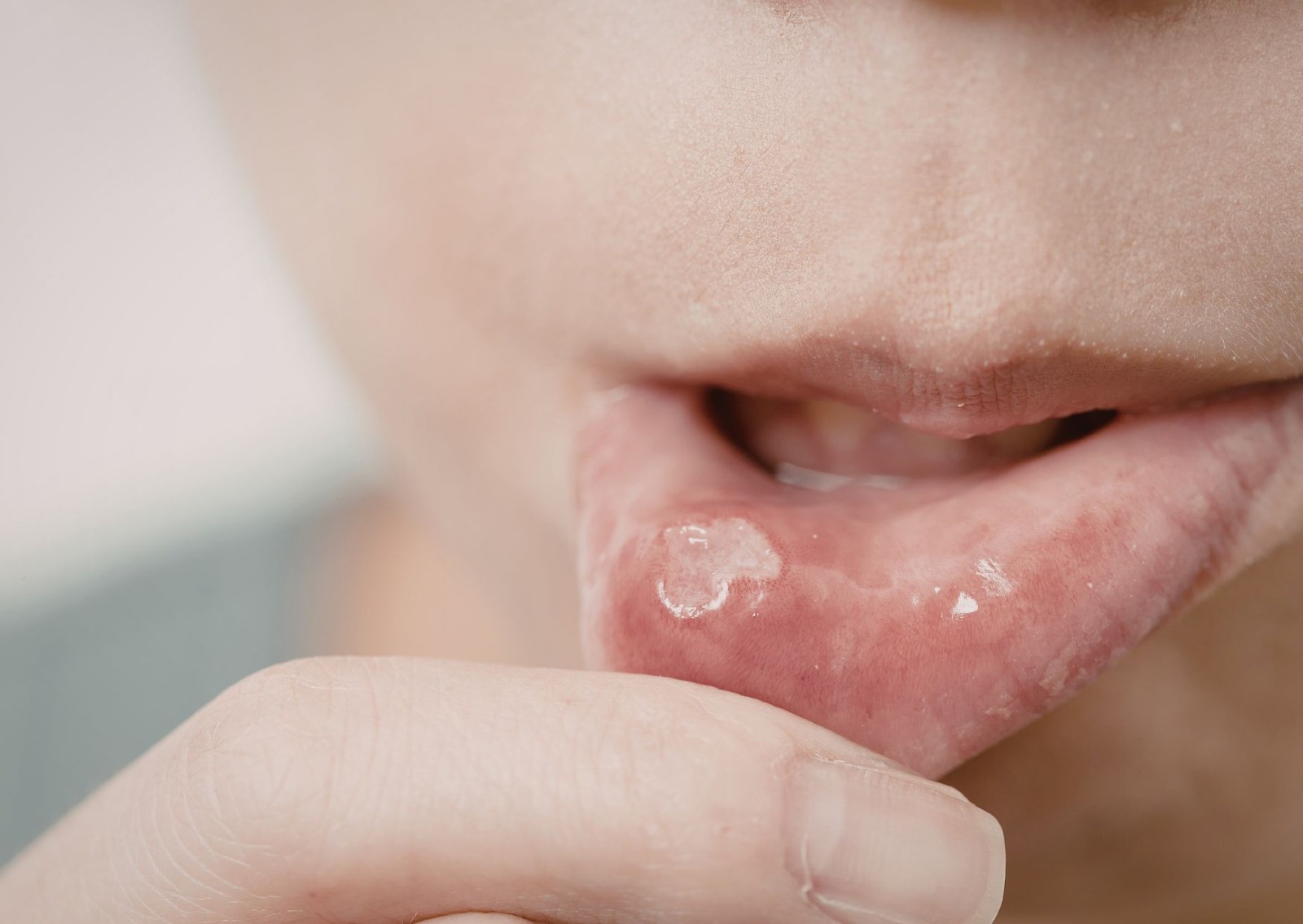 Doença do beijo e herpes: Saiba como proteger sua saúde bucal no Carnaval