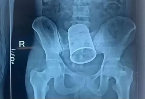 Durante bebedeira, homem enfia copo de lembrancinha de festa no ânus