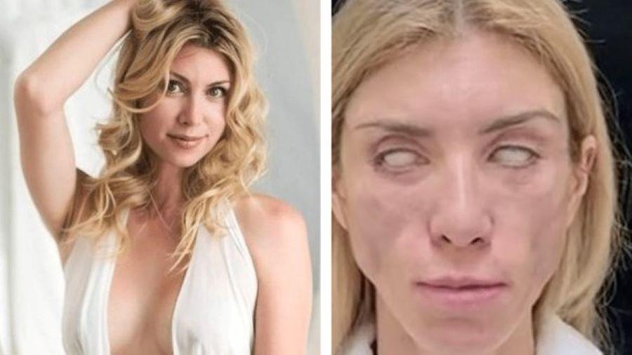 Miss diz que não consegue fechar os olhos após cirurgia plástica