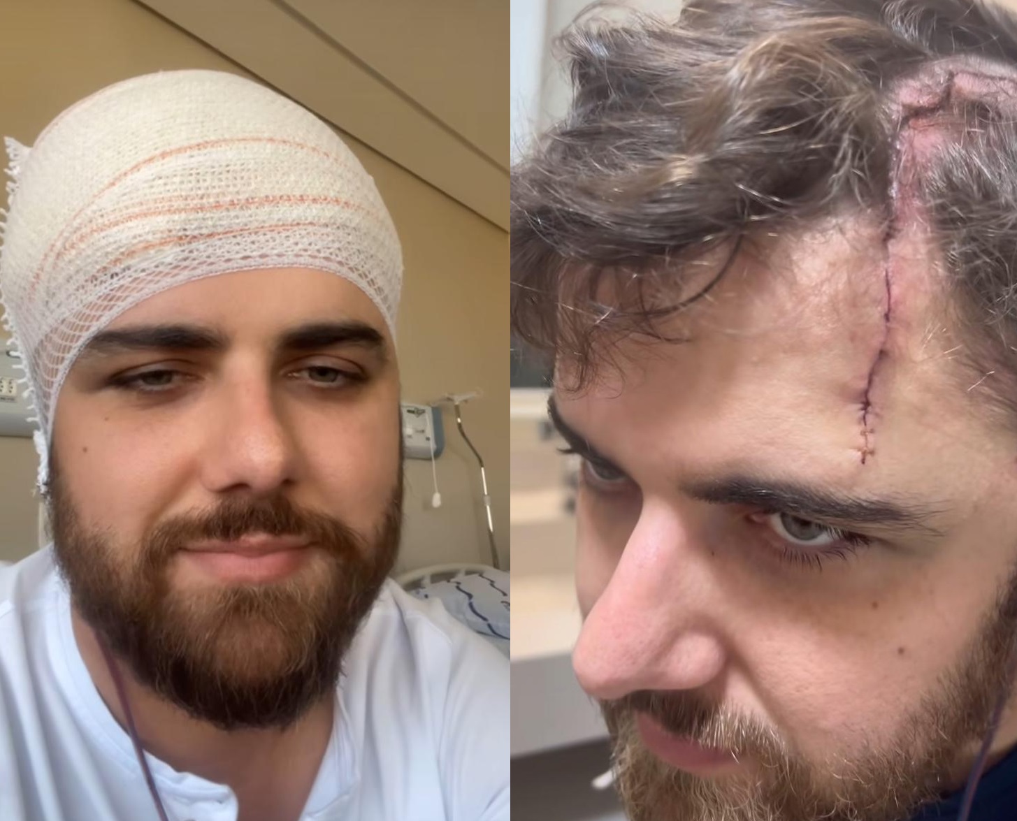 Zé Neto choca ao mostrar corte enorme na cabeça após acidente 