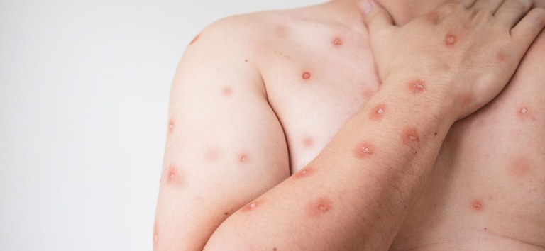 Primeiro caso de Mpox no Brasil em 2026 é confirmado em Porto Alegre