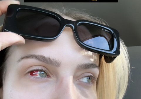 Tata Estanieck estoura veia no olho após coçar 