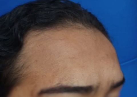 Jovem leva tiro de pressão durante arraial em shopping e fica com bala alojada no olho em Manaus