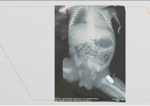 Bebê passa por cirurgia após ser baleada dentro da barriga da mãe