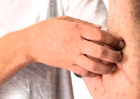 Oropouche: Amazonas apresenta redução de casos seguida de estabilidade da doença