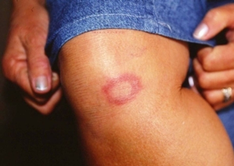 Governo capacitará profissionais da saúde para identificar Hanseníase