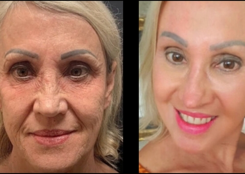 Peeling de fenol custa R$ 30 mil e promete rejuvenescer anos em uma sessão
