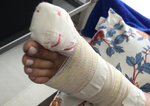 Durante compras, empilhadeira esmaga pé de cliente e dedão é amputado