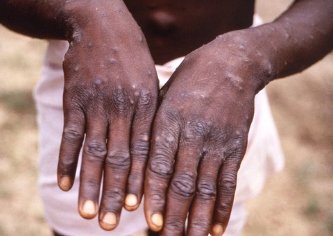 Veja lista de sintomas da varíola dos macacos e saiba como se proteger