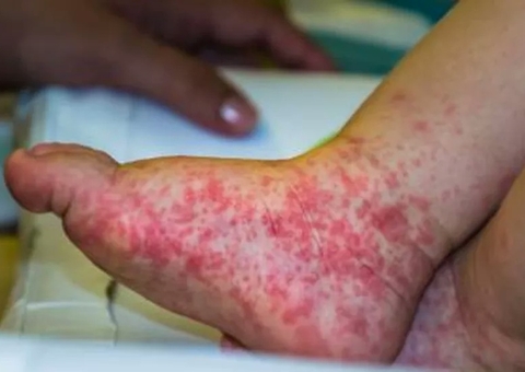 Gripe do Tomate: Surto tem quase 100 crianças infectadas na Índia