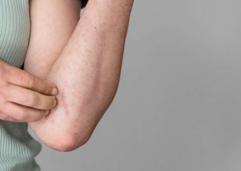 Febre Oropouche é tema de oficina do Ministério da Saúde em Manaus