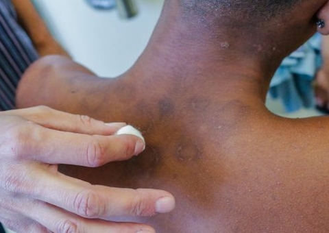 Ações para detectar novos casos de hanseníase são intensificadas em Manaus