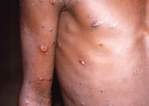 Paciente com sintomas de varíola dos macacos é acompanhado em Manaus