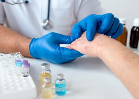 OMS avalia se mpox deve voltar a ser declarada emergência global