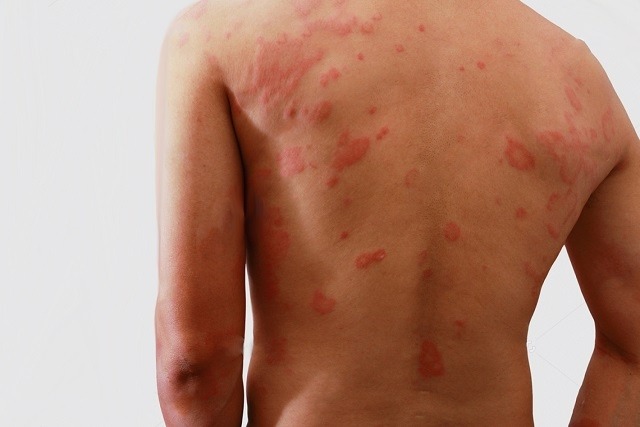 Janeiro Roxo: mês acende alerta para conscientização sobre a hanseníase