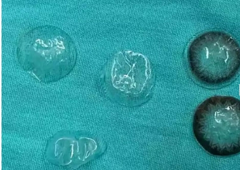 Mulher descobre cinco lentes de contato no olho após cirurgia