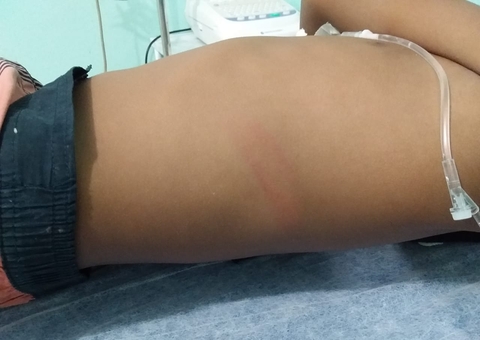 Menino de 8 anos é espancado pelo padrasto ao defender a mãe no Amazonas