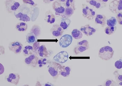 Ameba 'comedora de cérebro': conheça riscos e sintomas de infecção