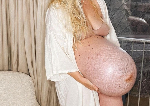 Mulher choca web com barrigão de trigêmeos; médica explica o caso