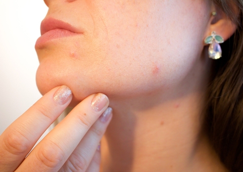 Esses fatores podem aumentar as chances de desenvolver acnes e cravos