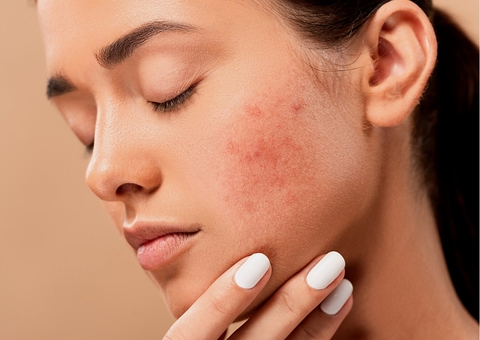 Prepare esta máscara anti-inflamatória para previnir as acnes 