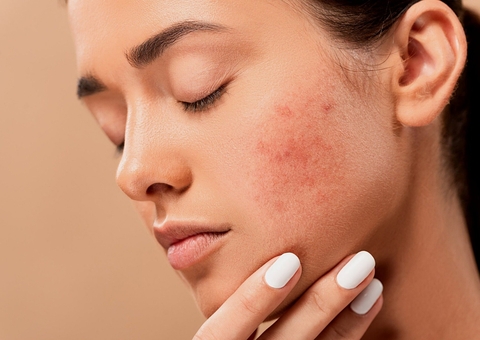 Tem acne? Então corte esse tipo de alimento para o bem da sua pele