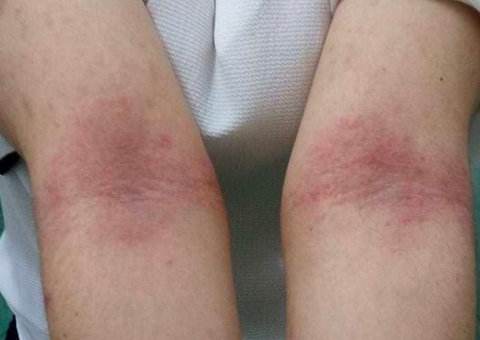 Ansiedade pode agravar os quadros de Dermatite Atópica