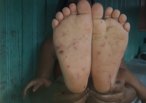 Criança de 3 anos apanha do pai com cipó e tem pés furados com espinhos