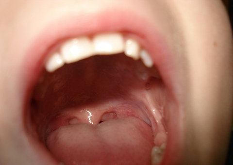 Infectologista explica tipos de amigdalite