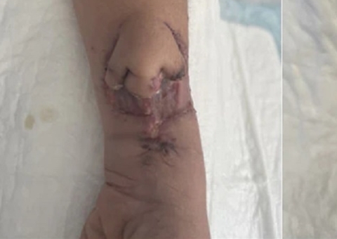 Nariz cresce em antebraço de mulher para transplante após câncer