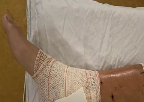 Triatleta leva mais de 50 mordidas durante ataque de pitbulls