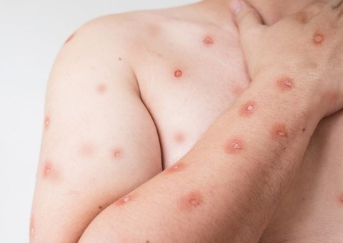 Infectologista explica sintomas e como se proteger da Mpox