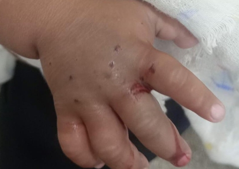 Bebê é transferido às pressas para Manaus após ser picado por cobra em Maués