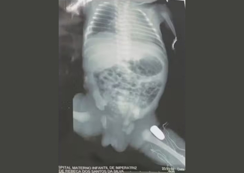 Grávida leva tiro na barriga durante assalto e bala fica alojada em bebê