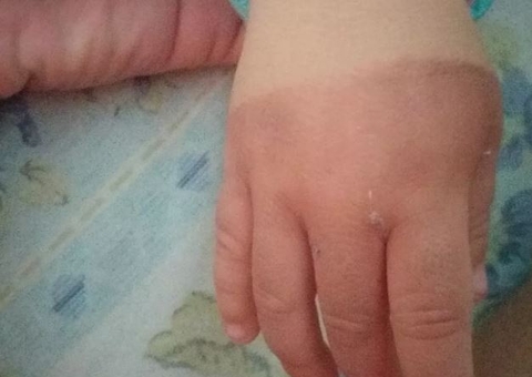 Babá é suspeita de queimar com água quente mão de bebê de 1 ano