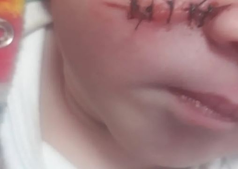 Bebê tem rosto cortado por médico durante cesárea