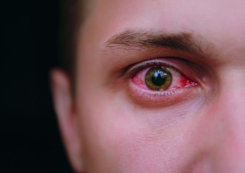 Clima seco e pandemia aumentam casos de olho seco