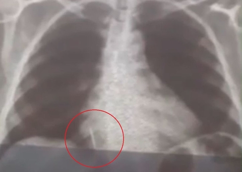 Mulher engole broca durante um procedimento de extração de dente