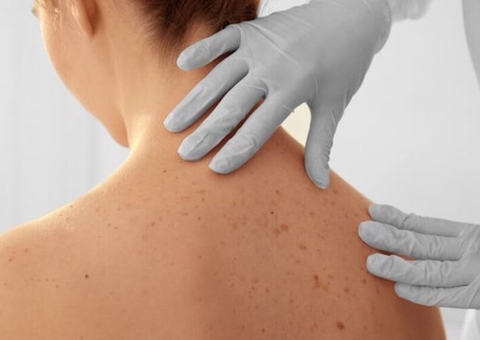 Dezembro Laranja: especialista dá dicas sobre prevenção do câncer de pele