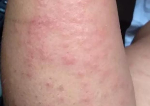 Surto de doença misteriosa atinge moradores de cidades em Pernambuco