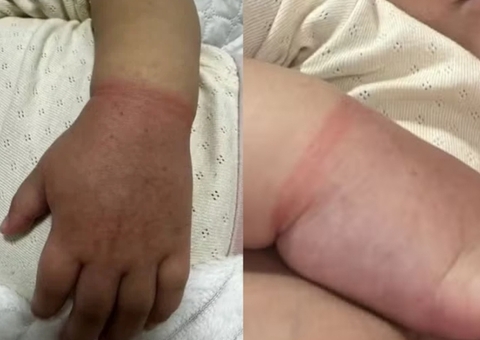 Menina de 2 anos quase perde o braço em Manaus por elástico de cabelo