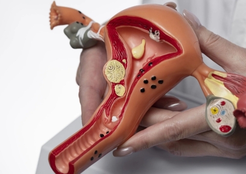 Endometriose pode levar de sete a dez anos para ser diagnosticada