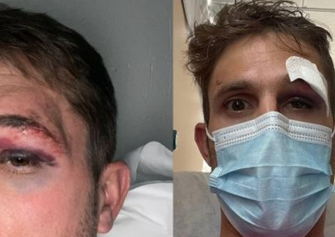 Ciclista é atropelado em treino para Volta da Espanha e mostra lesões