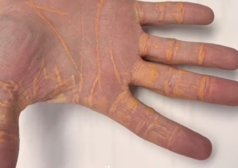 Colesterol 'vaza' pelas mãos de homem após aderir a dieta carnívora