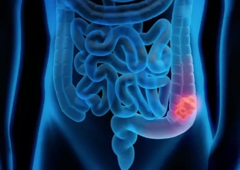 Câncer colorretal já é segunda doença mais letal do Brasil