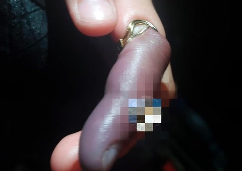 Criança prende argola na mão e quase tem dedo necrosado em Manaus