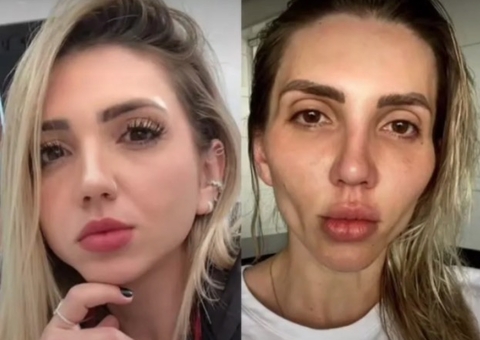 'Minha cara caiu', influencer desabafa sobre bichectomia; veja resultado