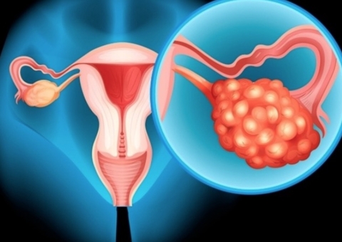 Câncer de Ovário: saiba mais sobre a doença que vitimou a atriz Eva Wilma