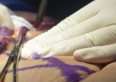 Mulher de 49 anos morre após cirurgia plástica 